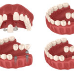 Drawings of different kinds of dental bridges