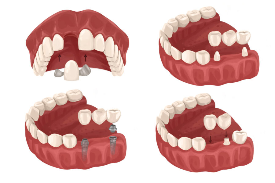 Drawings of different kinds of dental bridges