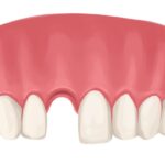 Drawing of an upper arch missing a front tooth