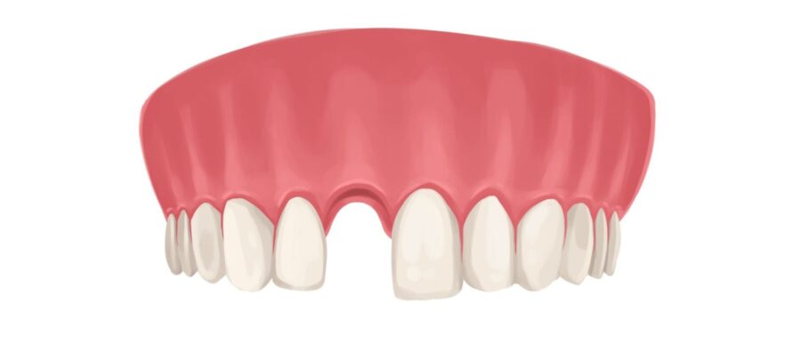 Drawing of an upper arch missing a front tooth