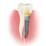 Illustration of half natural tooth and half dental implant