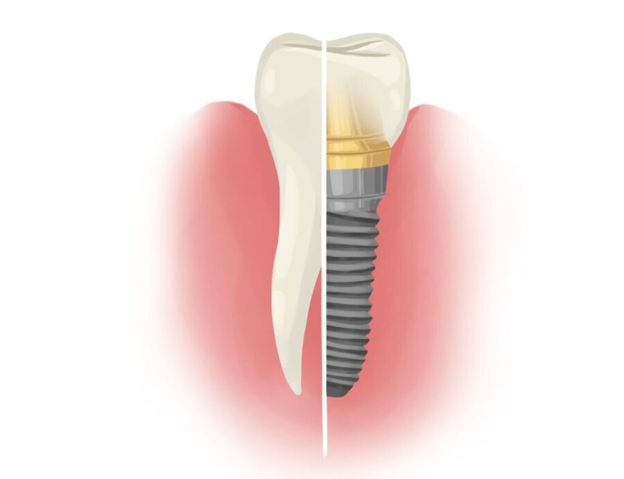 Illustration of half natural tooth and half dental implant