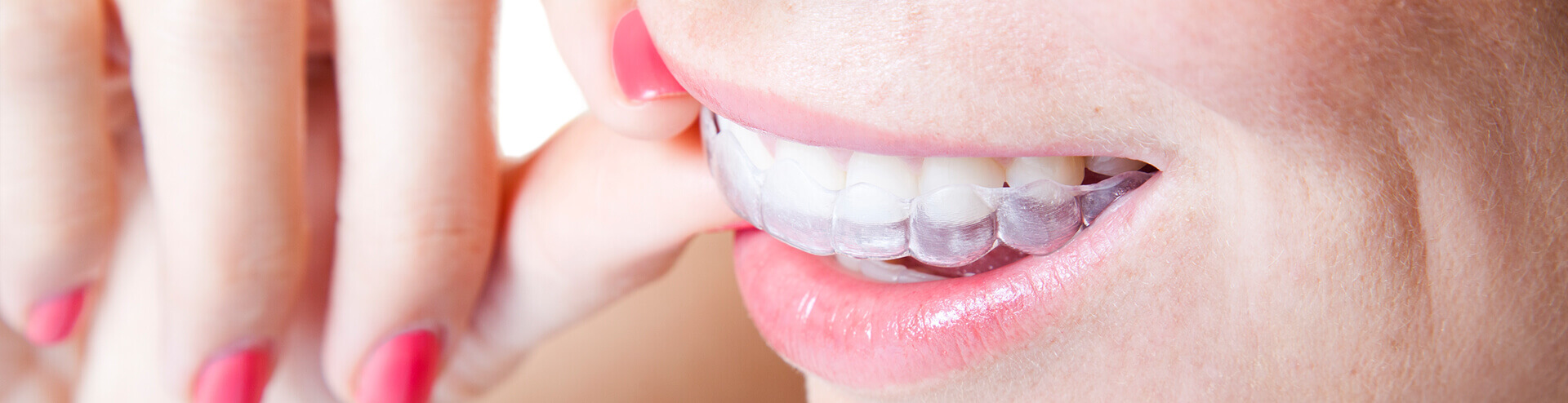 closeup of a person inserting a clear aligner onto their teeth