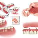 Illustration of dentures & dental implants to replace missing teeth