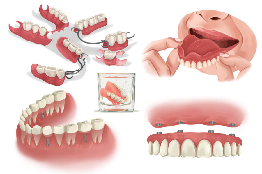 Illustration of dentures & dental implants to replace missing teeth