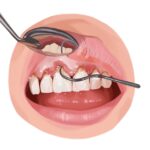 Illustration of a scaling and root planing treatment to treat gum disease