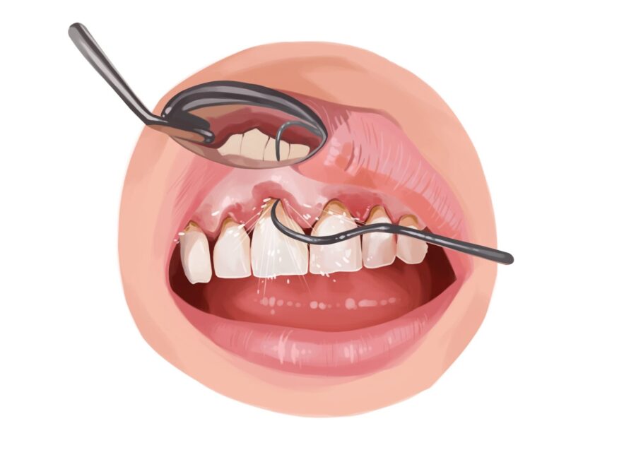 Illustration of a scaling and root planing treatment to treat gum disease