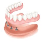Graphic illustration of All-on-4 dental implants on mandibular arch