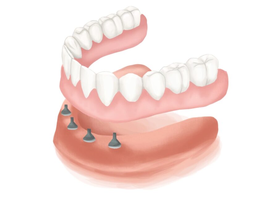Graphic illustration of All-on-4 dental implants on mandibular arch