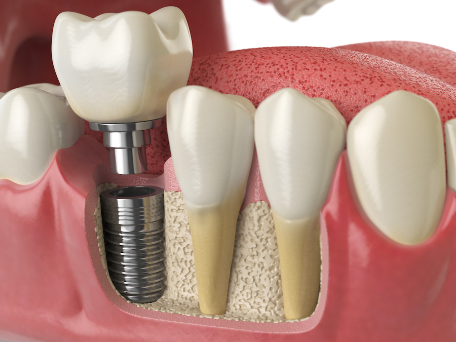 dental implants, dental implant, osseointegration, bone level, jawbone, jawbone health