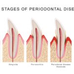 image of periodontal disease stages, what is a gum pocket