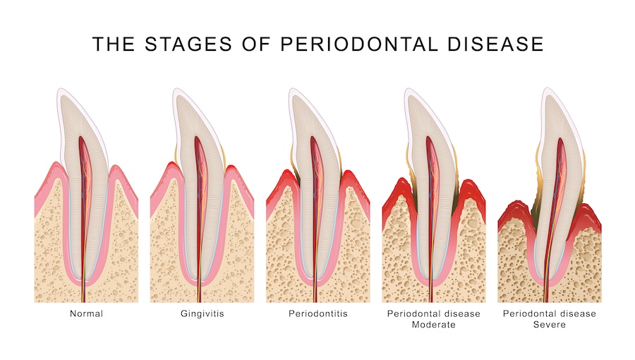 image of periodontal disease stages, what is a gum pocket