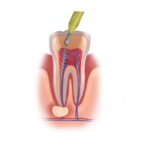 root canal therapy or extraction