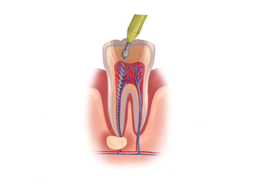 root canal therapy or extraction