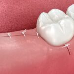 surgical tooth extraction stitches