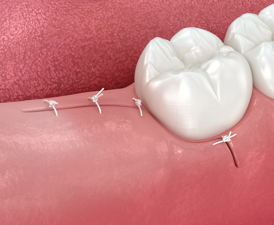 surgical tooth extraction stitches