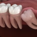 a wisdom tooth that would need surgical tooth extraction