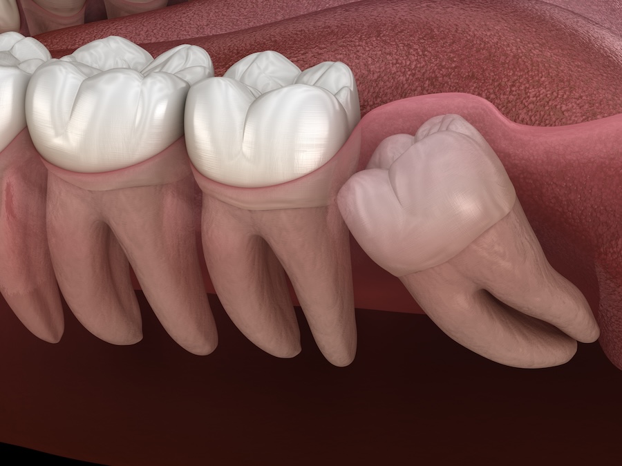a wisdom tooth that would need surgical tooth extraction